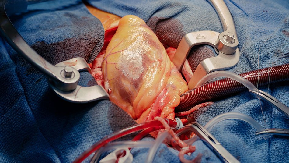 Cardiac-Heart-Surgery-Causes